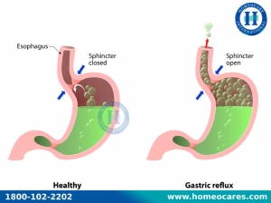 Best Homeopathy Treatment For Gastritis problem In HSRLayout